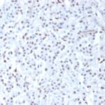 FFPE human mesothelioma sections stained with 100 ul anti-Wilms Tumor 1 (clone 6F-H2) at 1:200. HIER epitope retrieval prior to staining was performed in 10mM Citrate, pH 6.0.